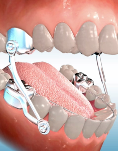 Overbite Correction - Herbst Appliance - Ashby Park Family Orthodontics